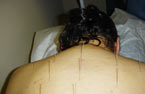 Acupuncture Houston, TX