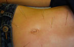Acupuncture Houston, TX