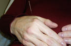 Acupuncture Houston, TX